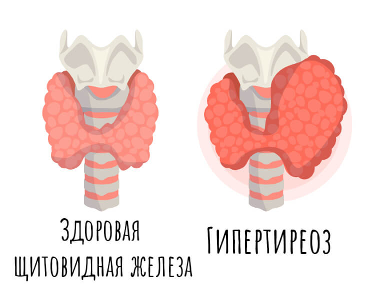 Гипертиреоз